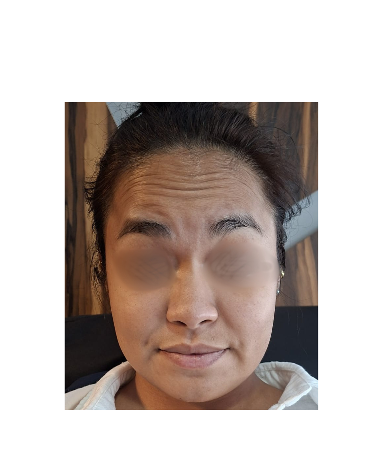 Antes Botox 'Mejora de arrugas dinámicas' 