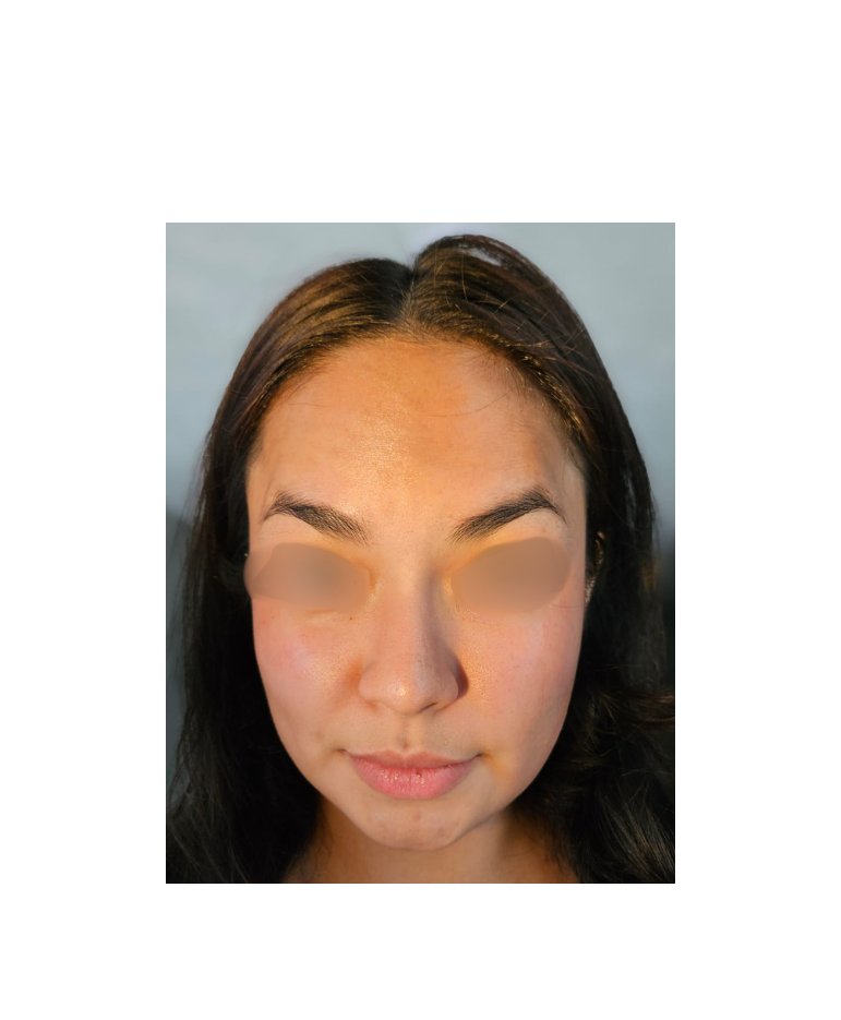 Después Botox 'Mejora de arrugas dinámicas' 