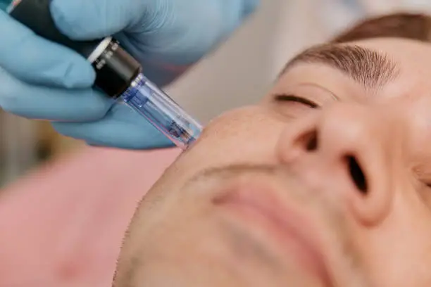 Bioestimulación de colágeno