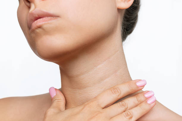 Toxina botulínica ''botox'' Cuello de Nefertiti en Guadalajara